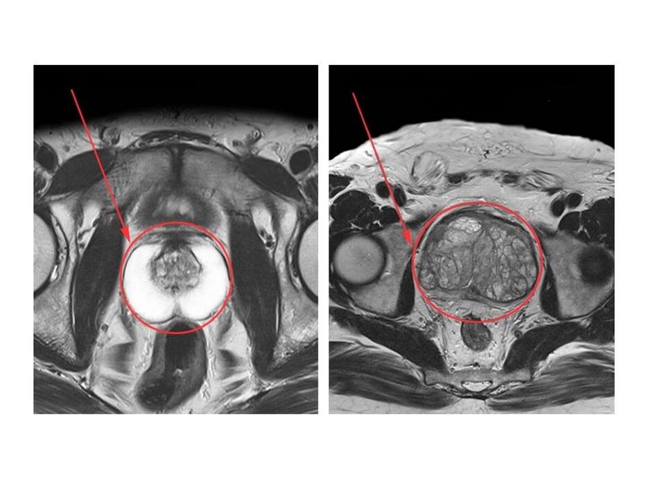 Egészséges (bal) és gyulladt (jobb) prosztata összehasonlítása MRI-képeken
